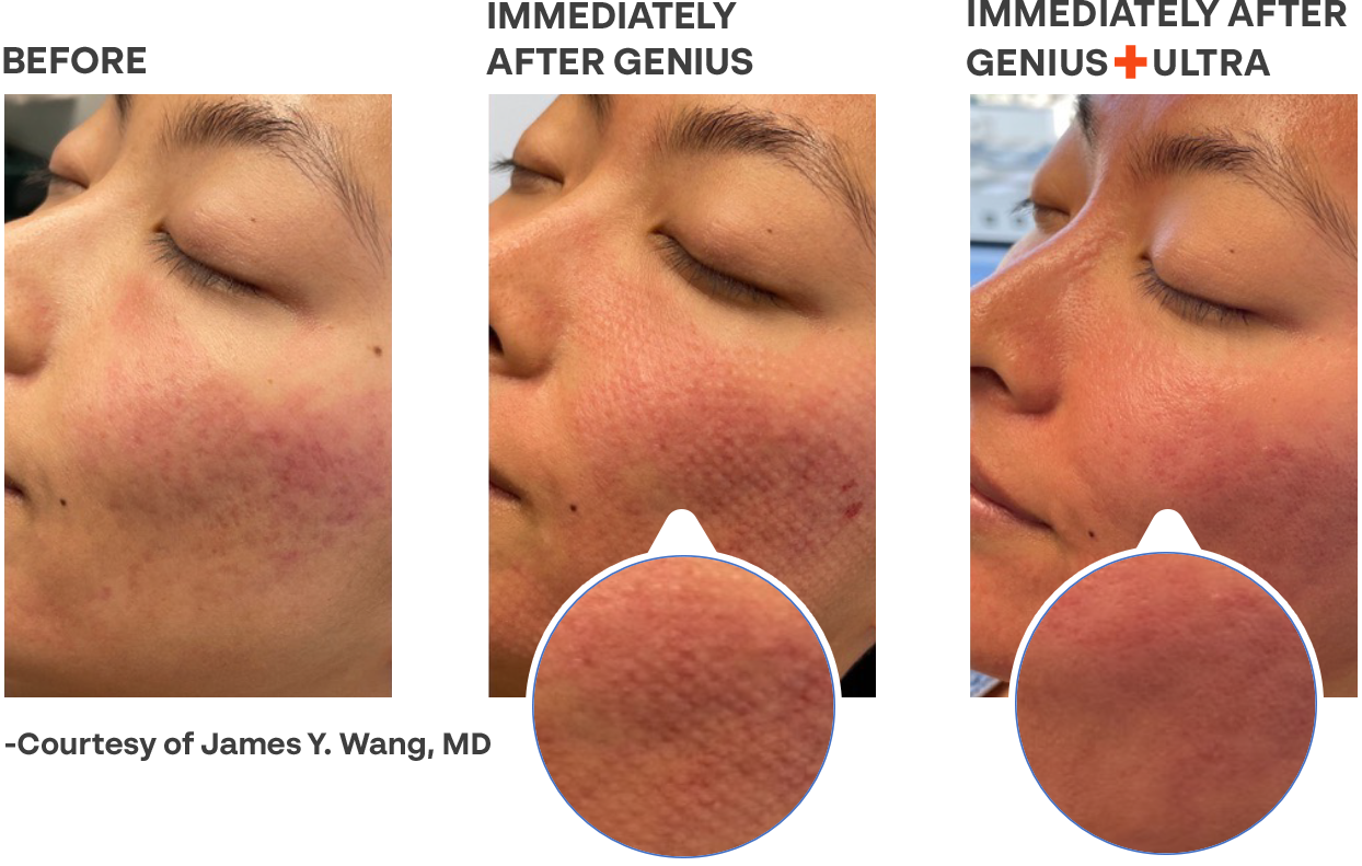Before and After Ultra Genius Results